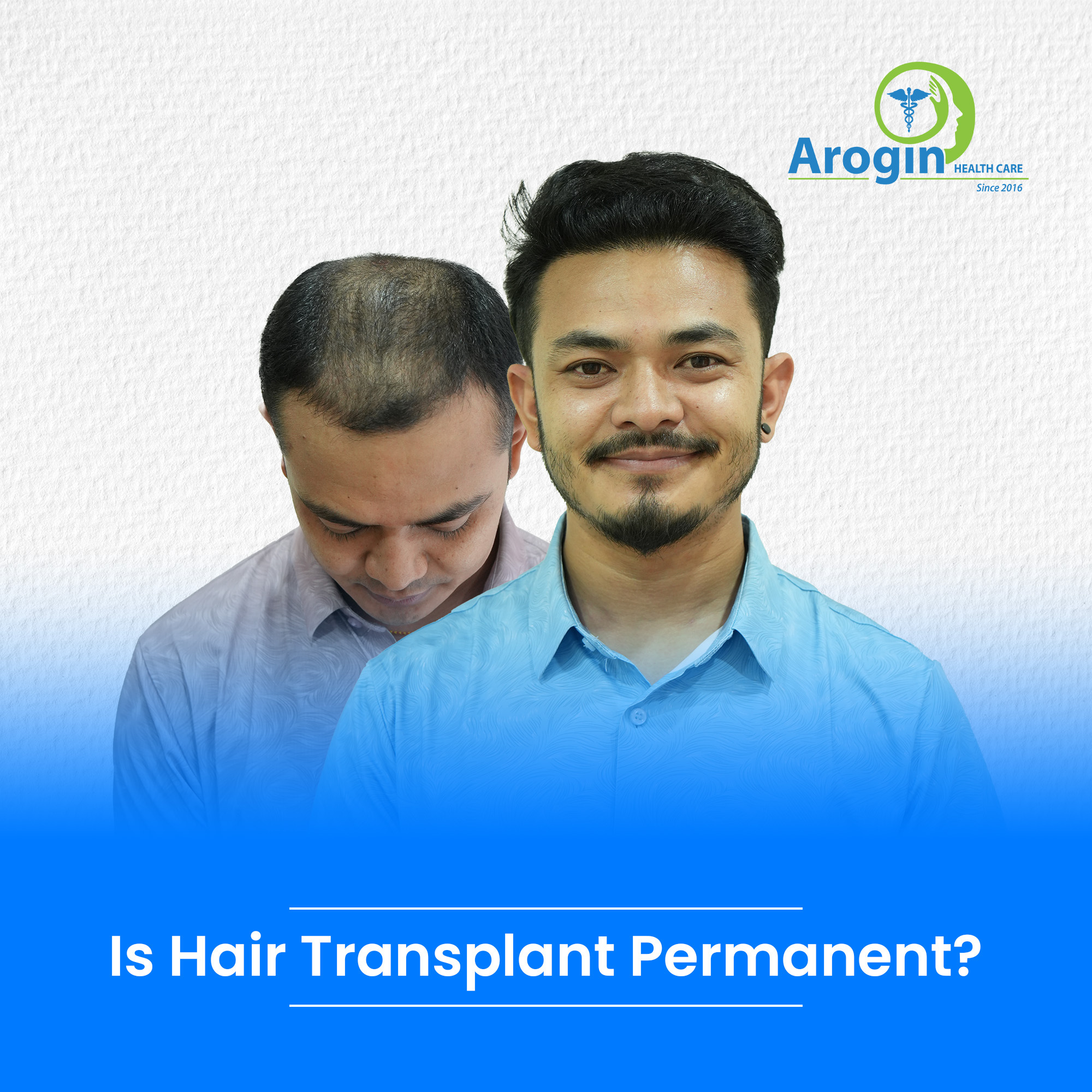 Is Hair Transplant Permanent? Full Guide on Lifelong Results & Care